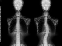 Test integral neuro-emocional y corporal escoliosis